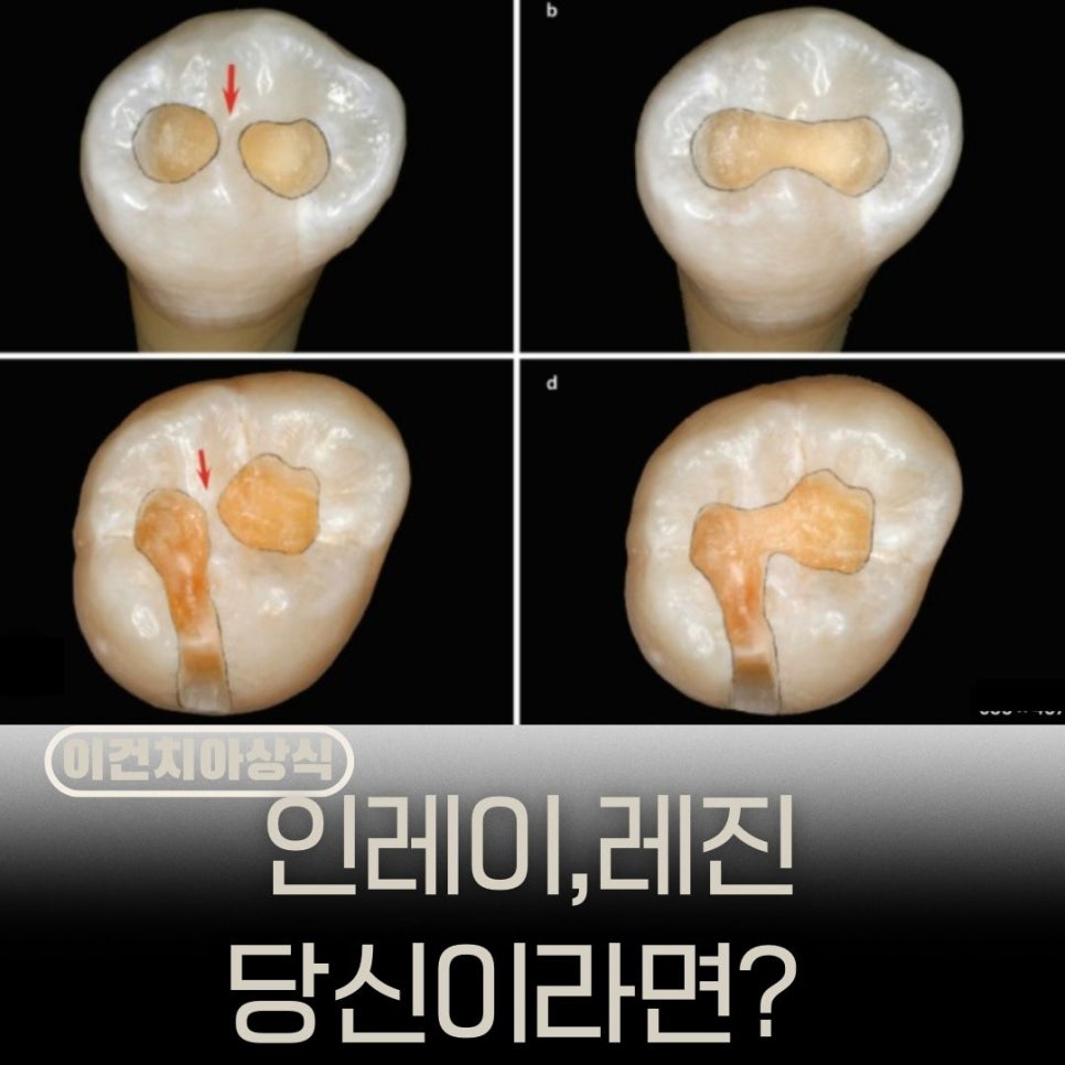 "인레이 대신 레진으로 치료받을 수 있나요?"