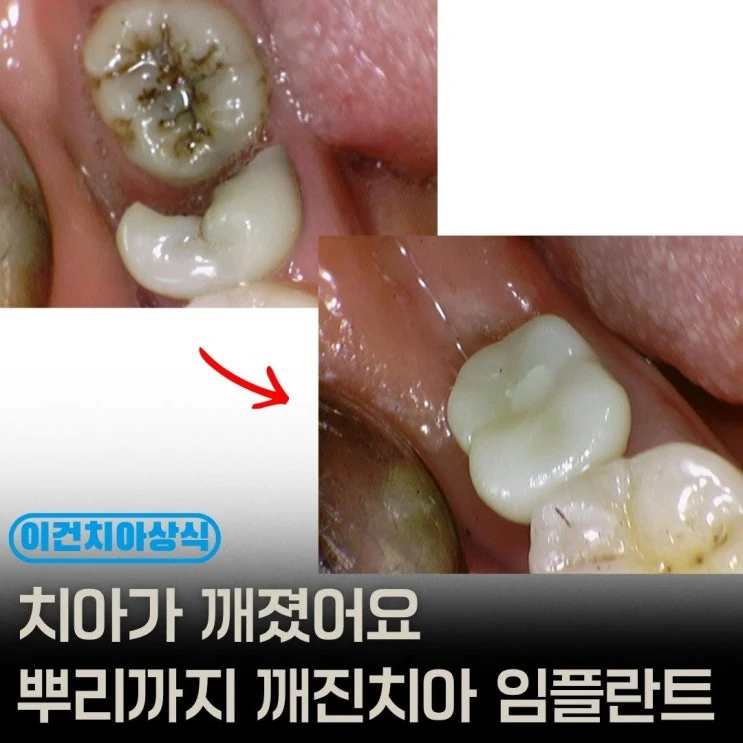 사랑니와 어금니 사이 충치 위험 설명 이미지