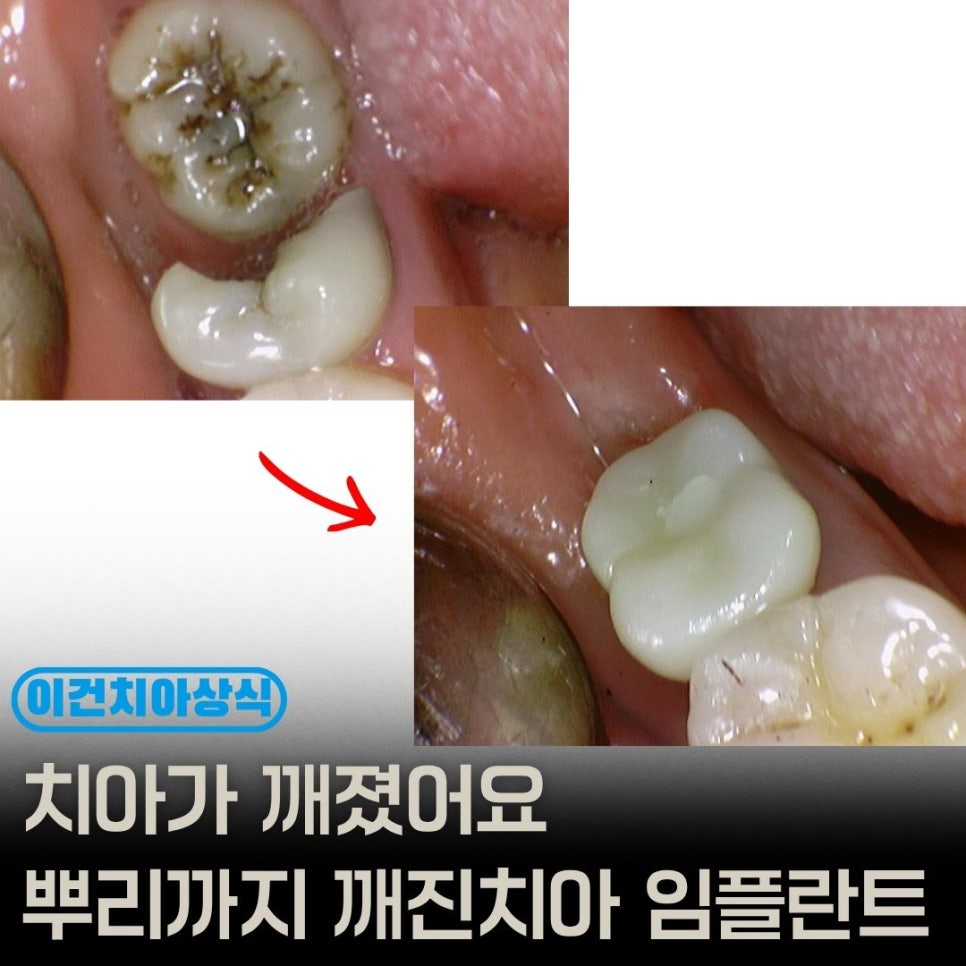 어금니가 반으로 깨졌다면 사랑니와 뿌리 파절까지 확인해야 합니다