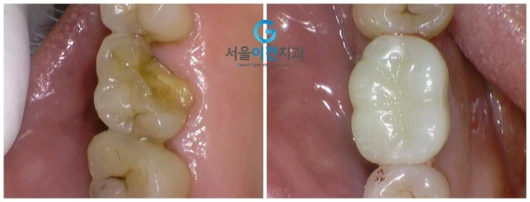 깊게 깨진 치아의 치료 전후 이미지