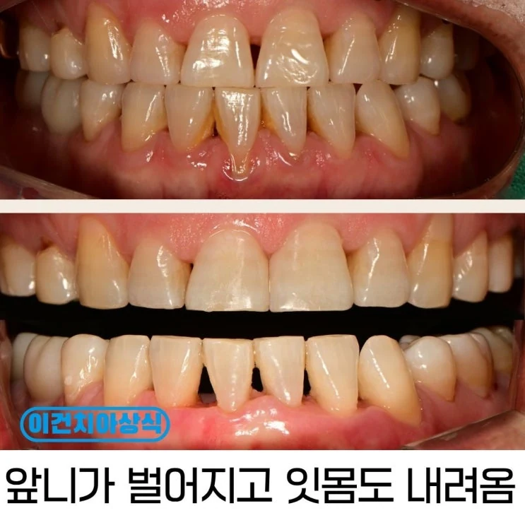 치은이식과 앞니 벌어짐 치료, 함께 개선할 수 있을까요?