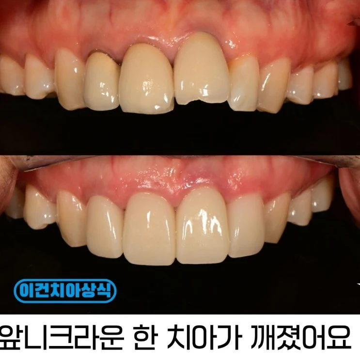 앞니 임플란트 보철, 다시 해야 할까요?