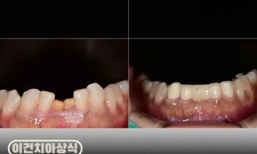 치아가 작아요, 왜소치 치료법 수원치과에서 라미네이트로 치료