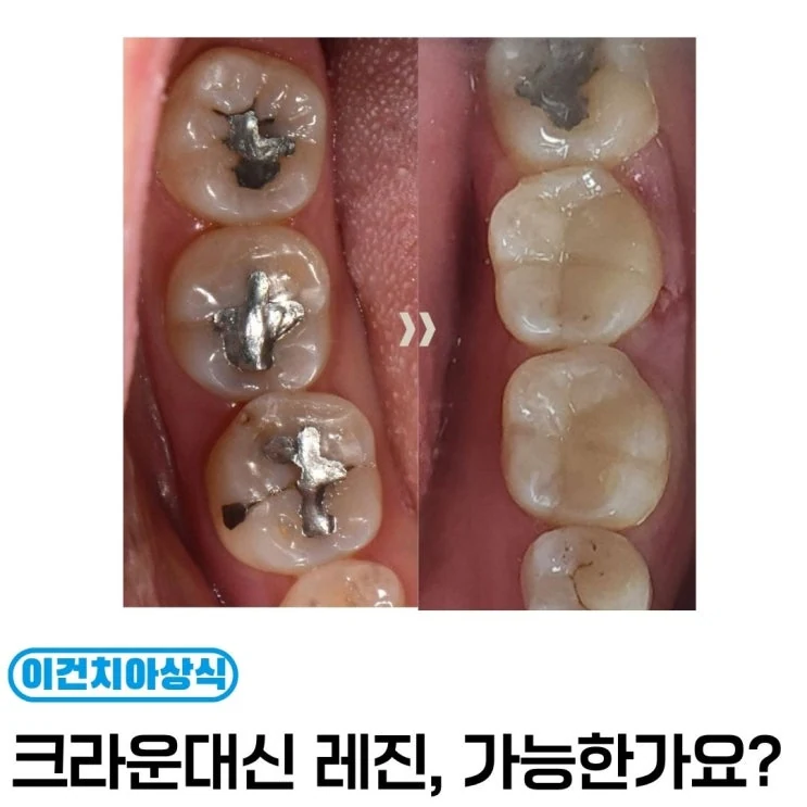 레진 빌드업, 아말감교체 레진으로 가능한가요?