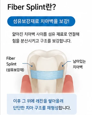 레진 빌드업, 아말감교체 레진으로 가능한가요?