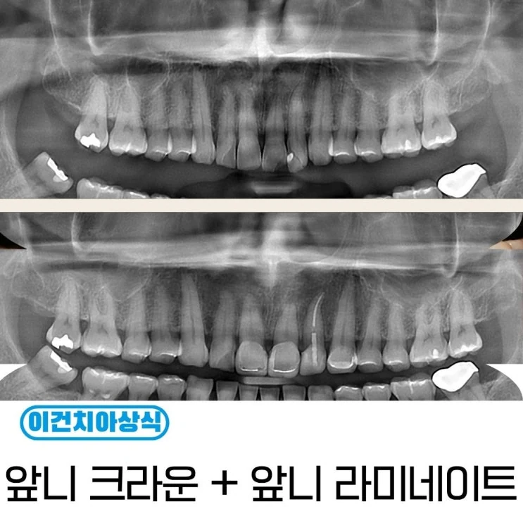 넘어져서 치아가 깨졌어요, 수원치과 심미보철
