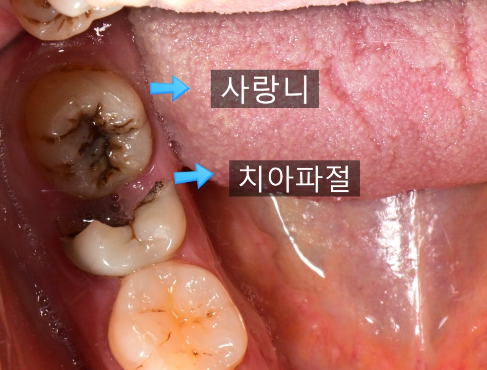 사랑니와 앞 어금니 사이 충치 확인