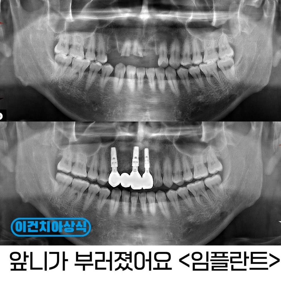 앞니가 빠졌을 때 임플란트가 필요할까요?
