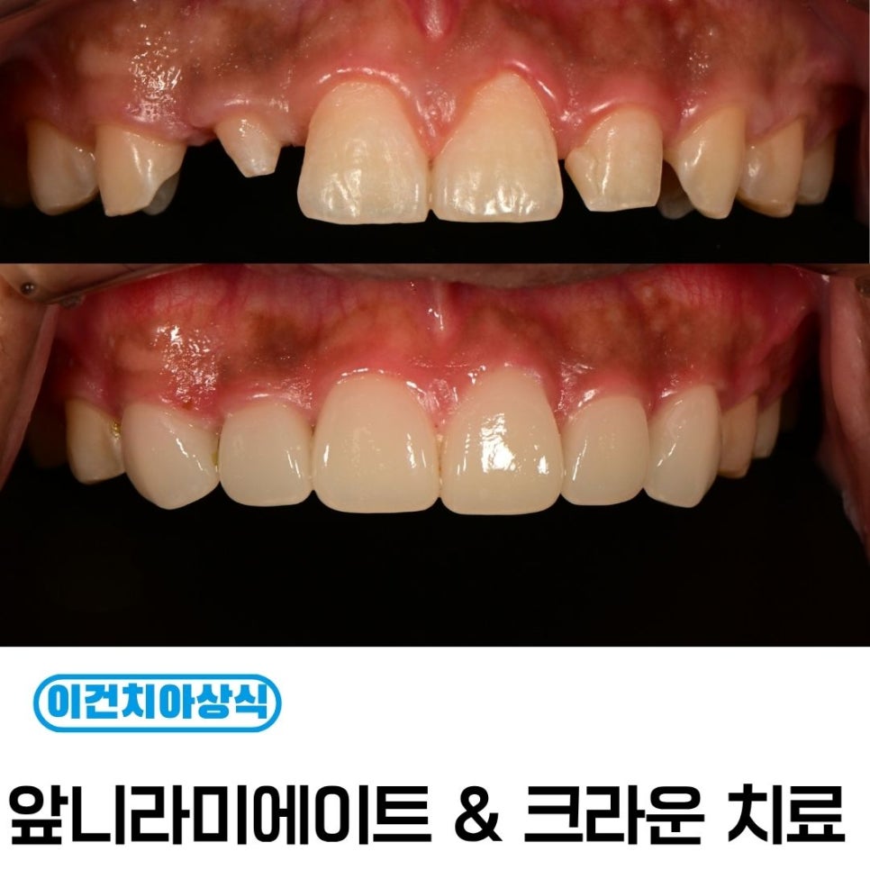 매복 송곳니 부분교정과 라미네이트 전 교정 계획