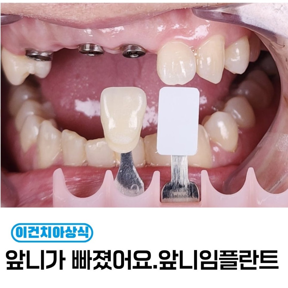 앞니가 빠졌을 때 임플란트가 먼저일까요