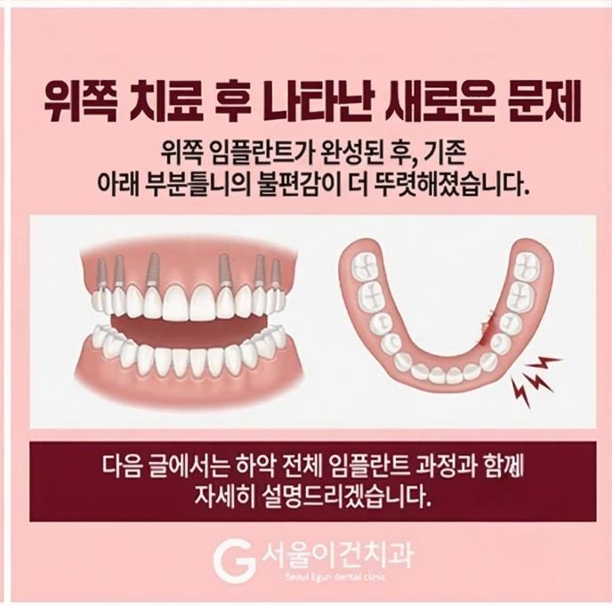 위 임플란트 후 아래 틀니가 더 아픈 이유