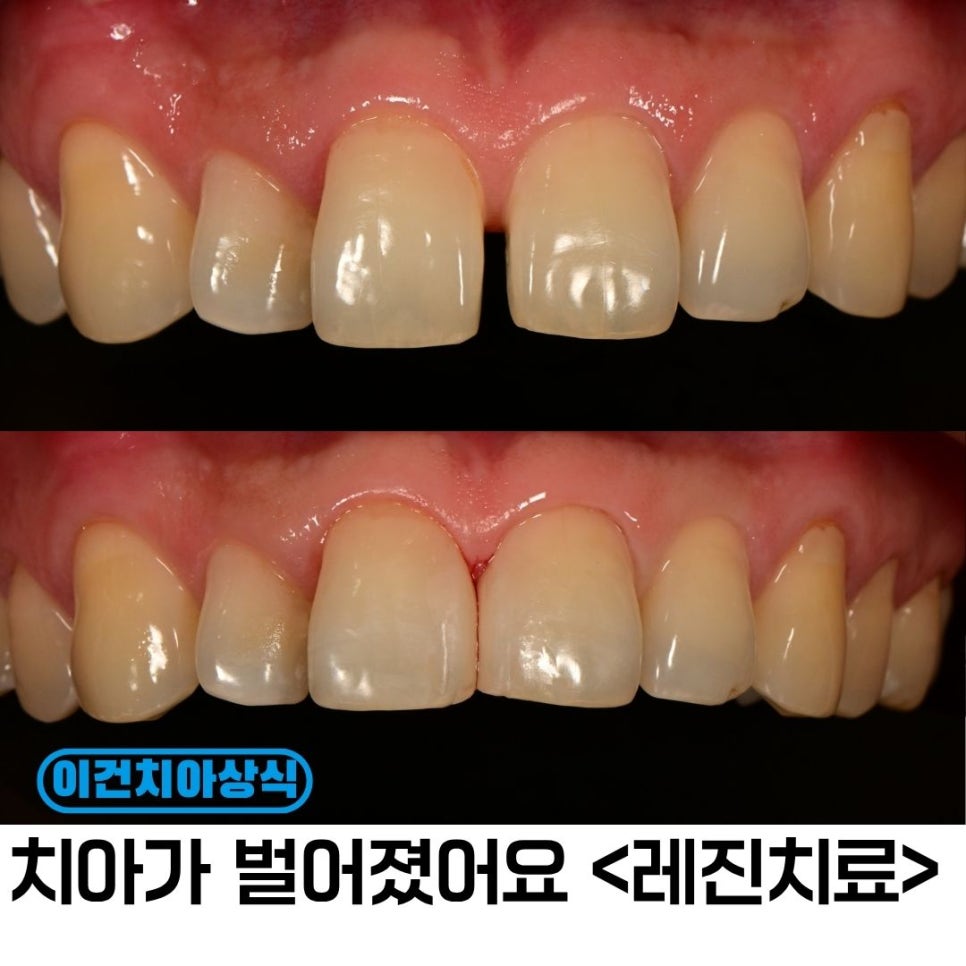 앞니 사이 벌어짐, 레진으로 채울 수 있을까요?